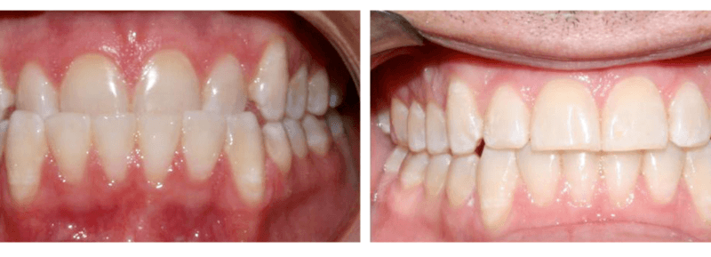 Before and after Invisalign in Ellensburg, WA