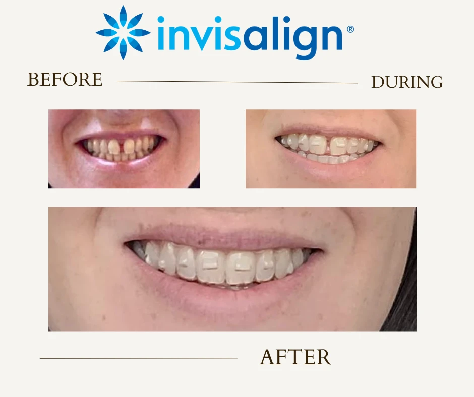 Before and after Invisalign in Ellensburg, WA