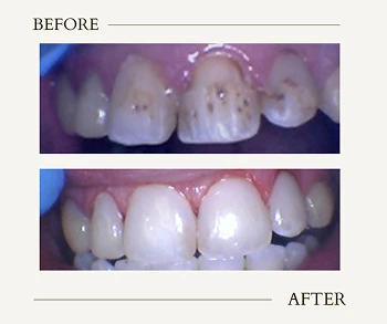 Before and after of dental crowns and fillings restoring damaged front teeth.