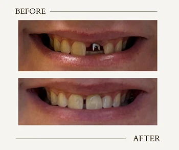 Before and after of a dental implant crown, showing improved smile and restored tooth.